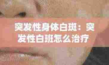 突发性身体白斑:突发性白班怎么治疗